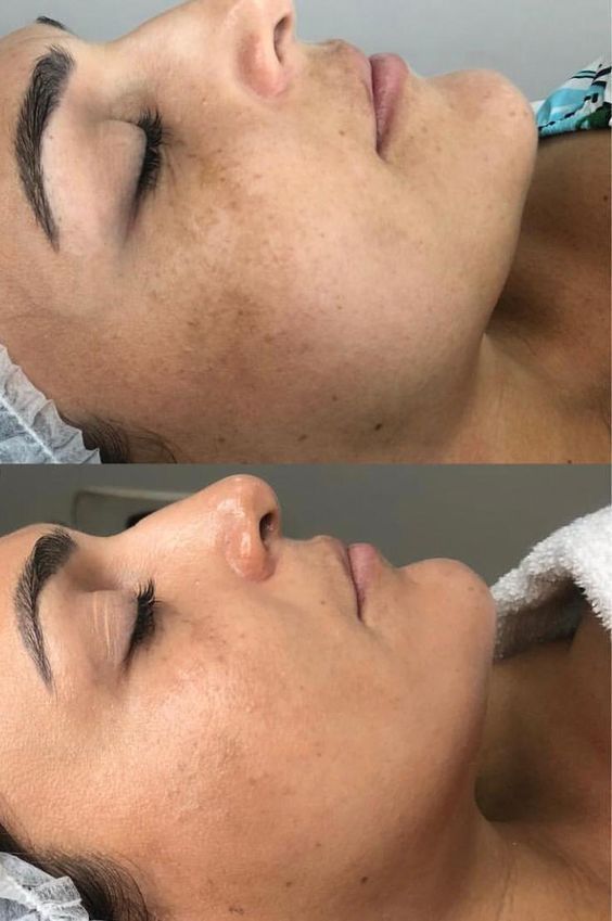 PROTOCOLO DESPIGMENTANTE FACIAL